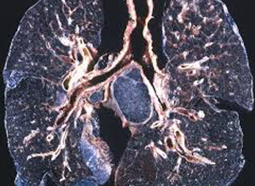 Occupational lung problems clinic